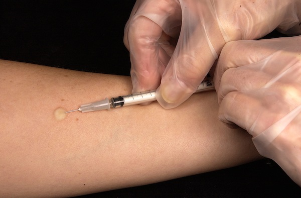 A tuberculosis test being administered. While TB is largely a disease of the past for Americans, it still occurs with some regularity among homeless people.